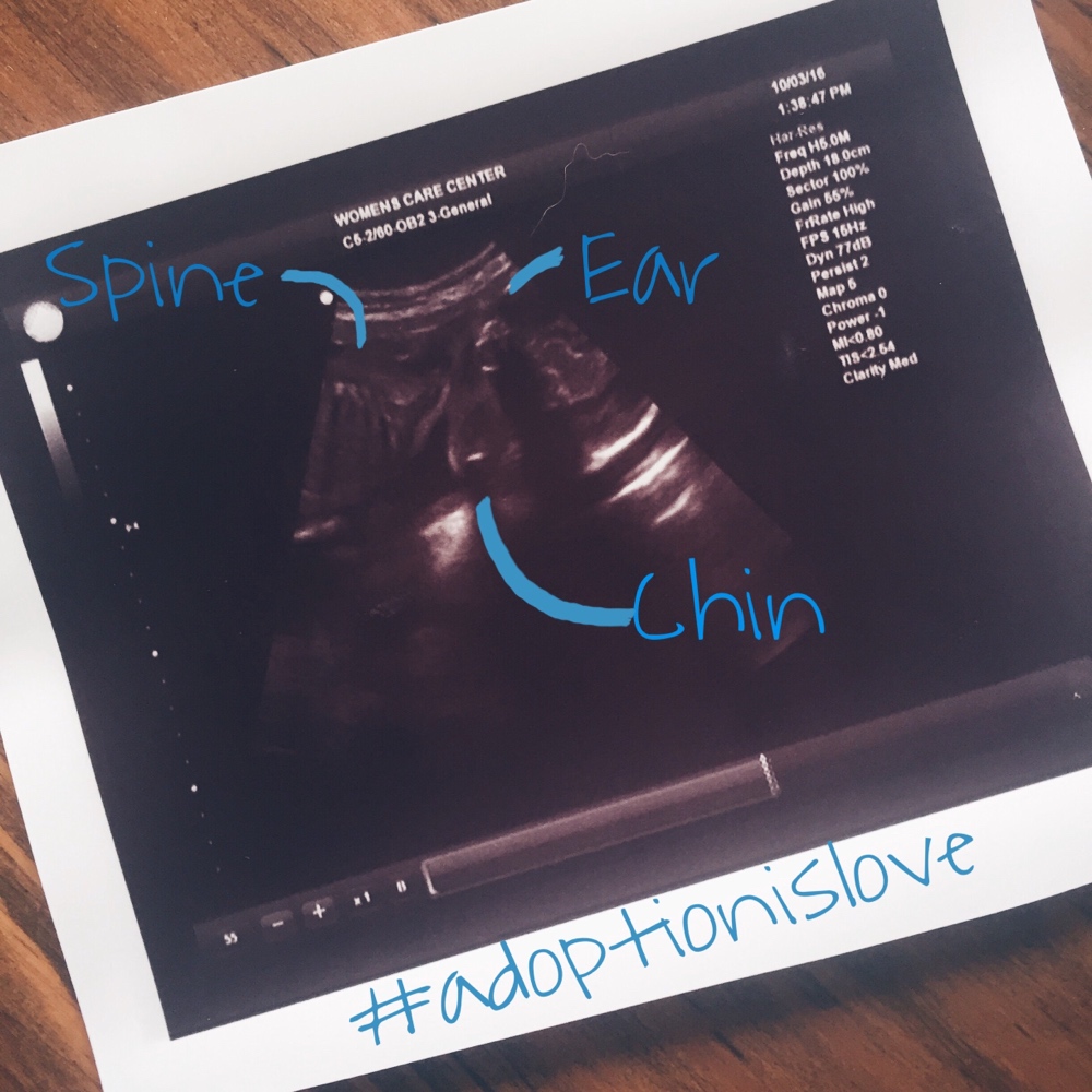 Ultrasound
